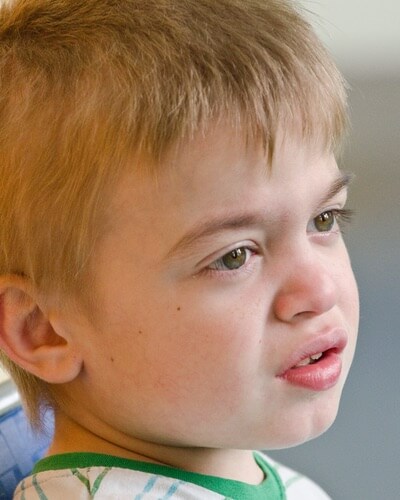 Course facial features in boys may be symptoms of Hunter syndrome
