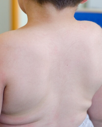 Scoliosis and kyphosis may be symptoms of Hunter syndrome