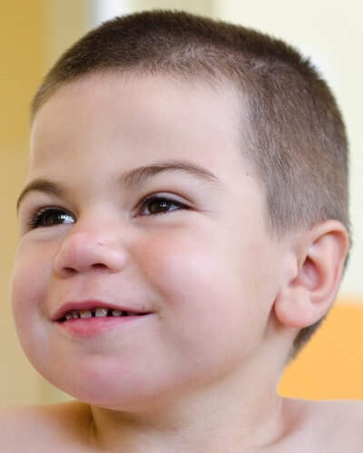 Widely spaced teeth in young boys may be a symptom of Hunter syndrome