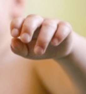 Carpal Tunnel Syndrome in Hunter syndrome patient