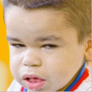 Enlarged mouth and tongue in Hunter syndrome patient