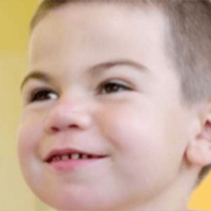 Peg-shaped, widely-spaced teeth in Hunter syndrome patient