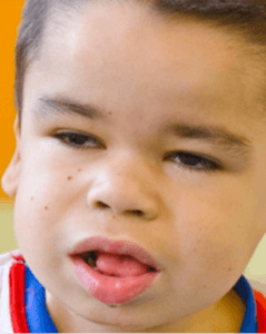 Large, protruding tongue in hunter syndrome patient
