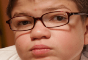 Loss of vision in hunter syndrome patients