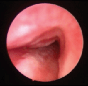 Tracheomalacia in hunter syndrome patient viewed on airway endoscopy