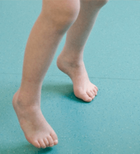 Abnormal bone thickness in hunter syndrome patient