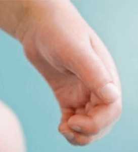 Claw-like hands in hunter syndrome patient