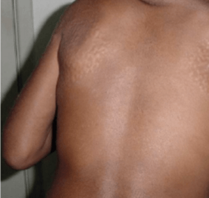 Ivory white papules on skin in hunter syndrome patient