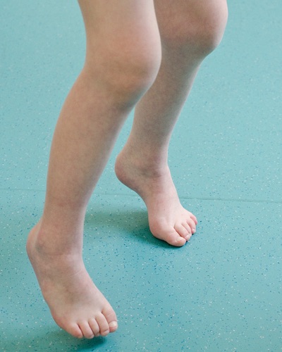 Abnormal bone shape in young boys may be symptoms of Hunter syndrome