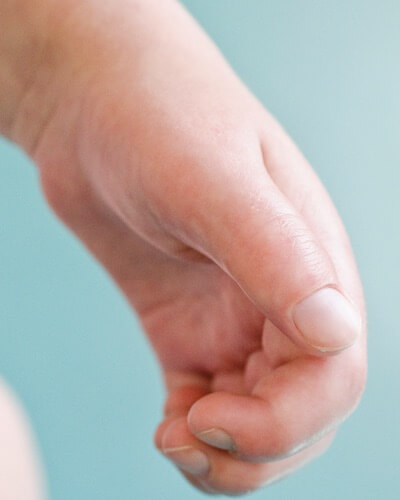 Claw like hands and carpal tunnel in young boys may be symptoms of Hunter syndrome