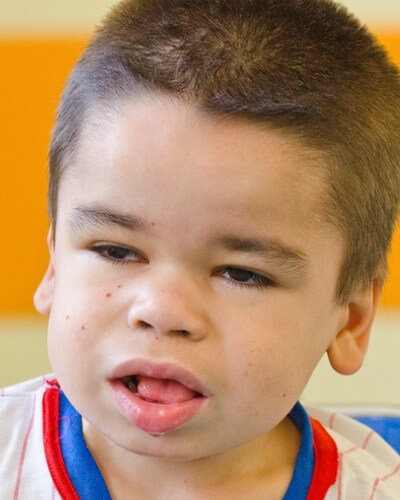Enlarged mount and tongue in boys may be symptoms of Hunter syndrome