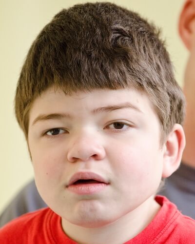 Large Head and Brow, Thick Lips and Broad Nose in boys may be symptoms of Hunter syndrome