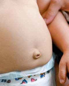distended_abdomen