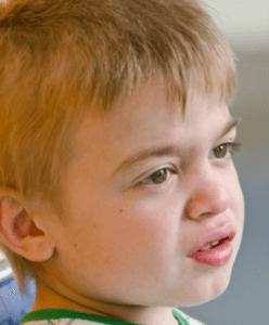 Ear Infections present in Hunter syndrome patient