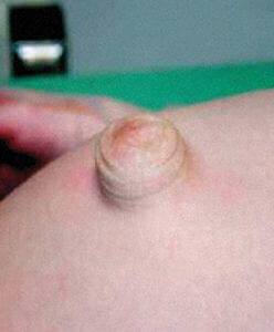 Hernia in a Hunter syndrome (MPS II) patient